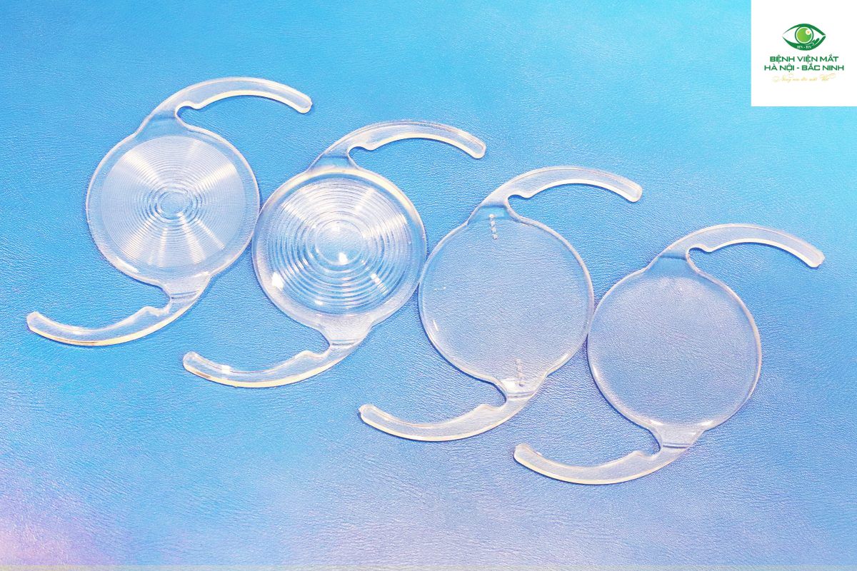 Thuỷ tinh thể đơn tiêu cự là gì?