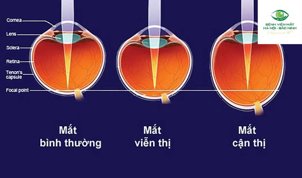 Tật khúc xạ là gì?