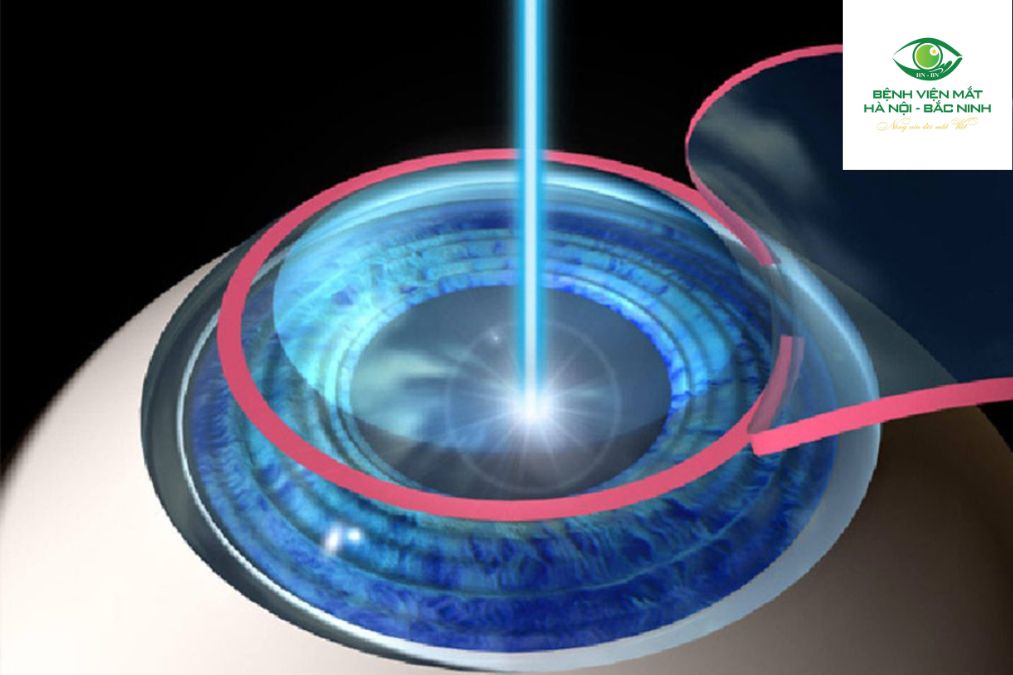 Phẫu thuật cắt dịch kính là gì?