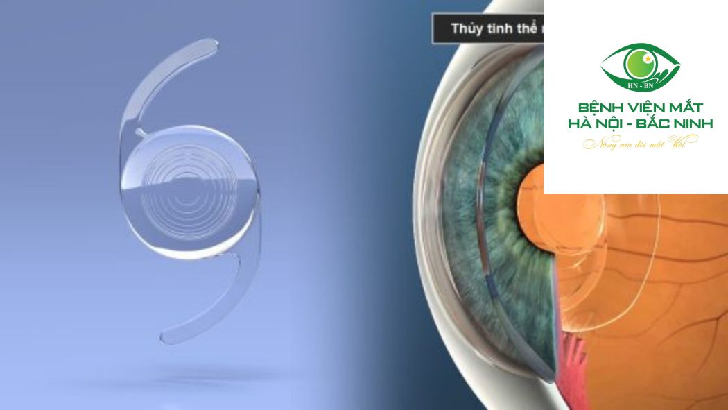 Nhờ thiết kế quang học đơn giản, độ an toàn cao và khả năng duy trì thị lực