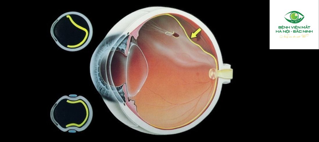 Chăm sóc và theo dõi sau laser quang đông